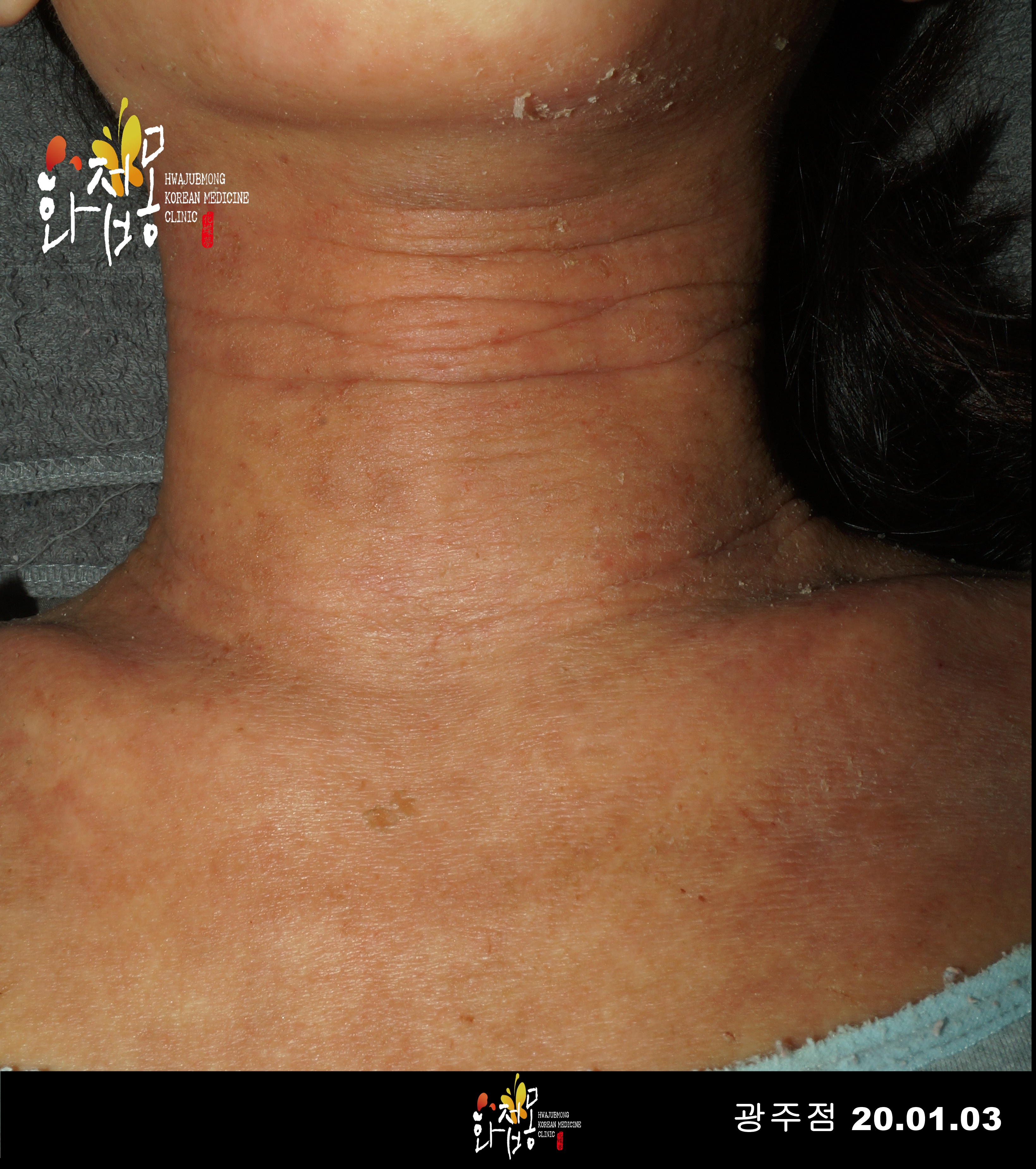 전후사진