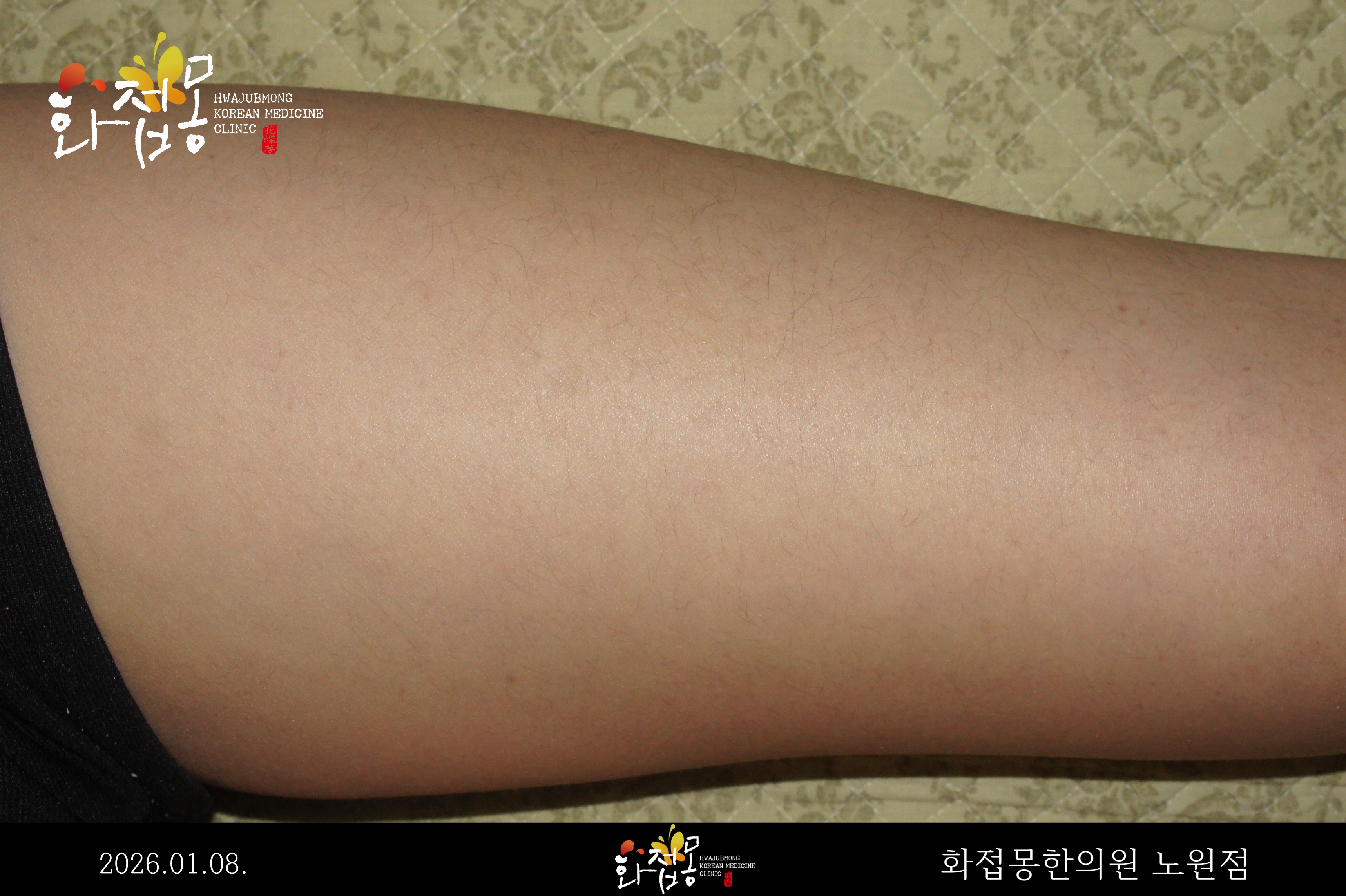 전후사진