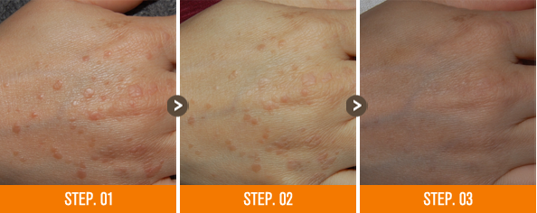 화접몽한의원 편평사마귀 전후사진