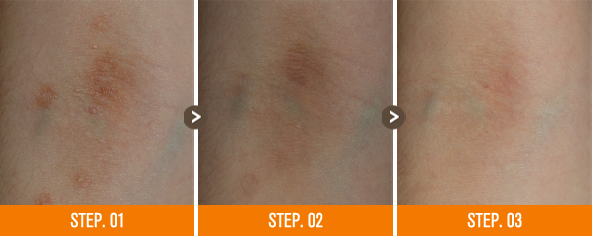 화접몽한의원 편평사마귀 전후사진