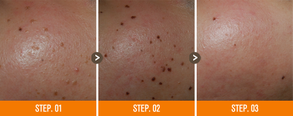 화접몽한의원 편평사마귀 전후사진