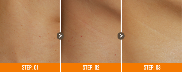 화접몽한의원 편평사마귀 전후사진