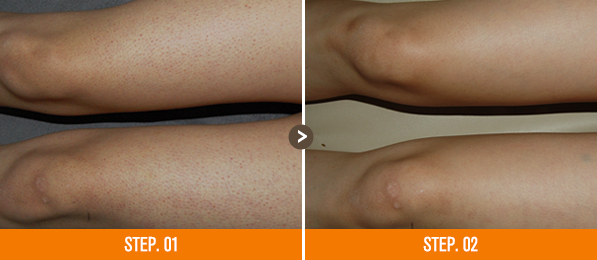 화접몽한의원 모공각화증 전후사진